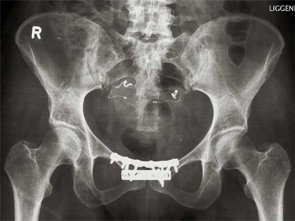 X-ray of pelvis, with screws and all